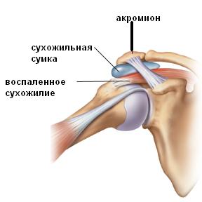 Аrthroscopy of shoulder joint Аrthroscopy of shoulder joint