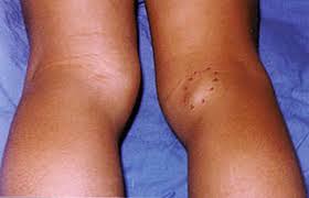 Knee joint disease. Baker's cyst Knee joint disease. Baker's cyst