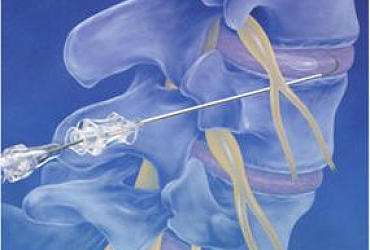 Epidural neurolysis (Racz procedure)