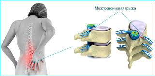 Микродискэктомия