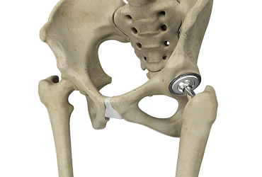 Искусственный сустав бедра