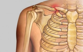 Fraktur des Schlüsselbeins