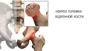 Асептический некроз головки бедра