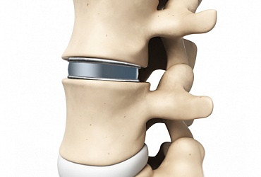 Эндопротезирование межпозвоночного диска