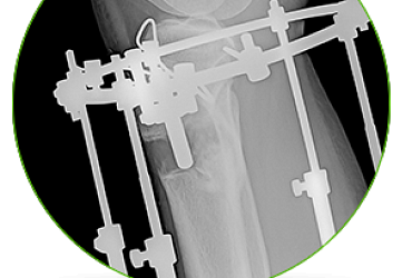 Увеличение роста