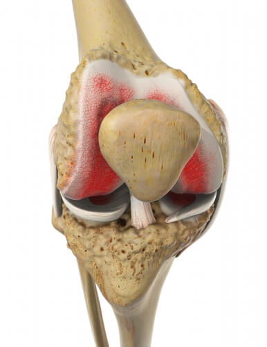 Еndoprosthesis of knee joint Еndoprosthesis of knee joint