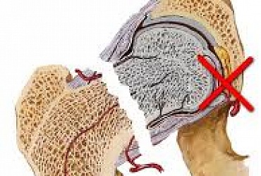 Fracture of femur neck