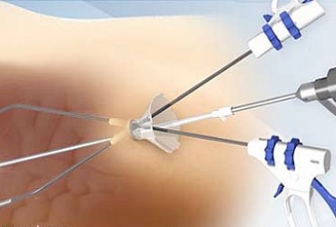Laparoscopic operation