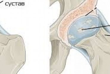 Coxarthrose (Arthrose des Hüftgelenks)