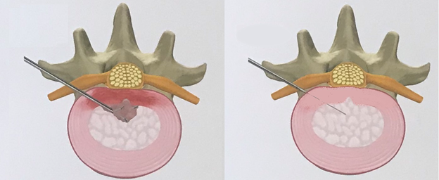 Transplantation von autologen Zellen der Bandscheibe (ADCT)