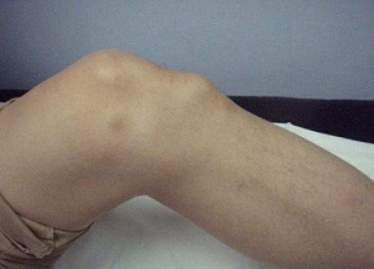 Osgood Schlatter-Krankheit