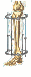 Увеличение роста