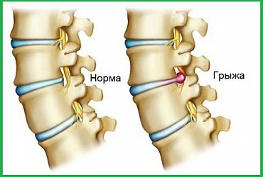 Микродискэктомия