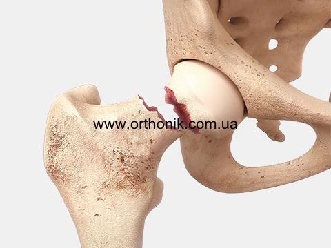 Bruch des Hüfthalses