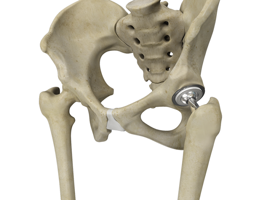 Artificial hip joint Artificial hip joint