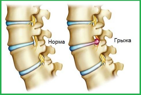 Microdiscectomy Microdiscectomy