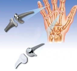 Еndoprosthesis of joints of hand Еndoprosthesis of joints of hand
