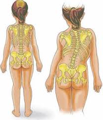 Scoliosis Scoliosis