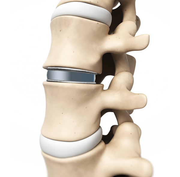 Эндопротезирование межпозвоночного диска